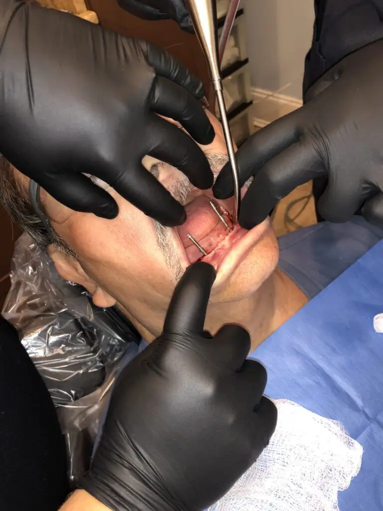 Dental Implant Procedure