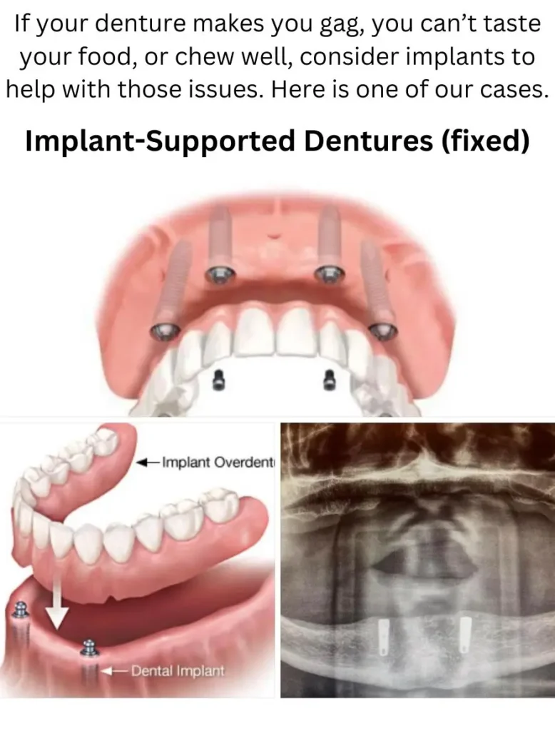 Implant-Supported Dentures